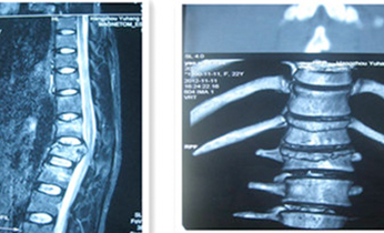 頸、胸、腰椎手術治療